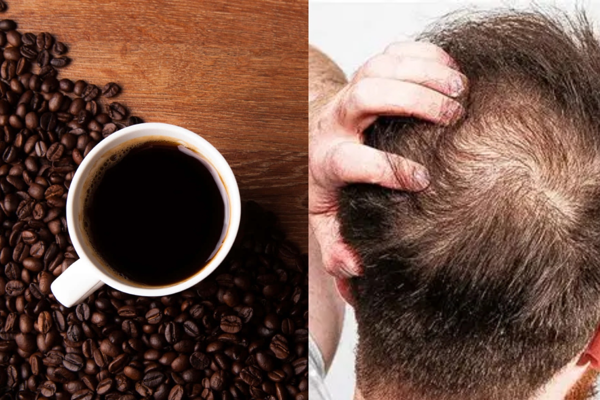 café calvície anvisa